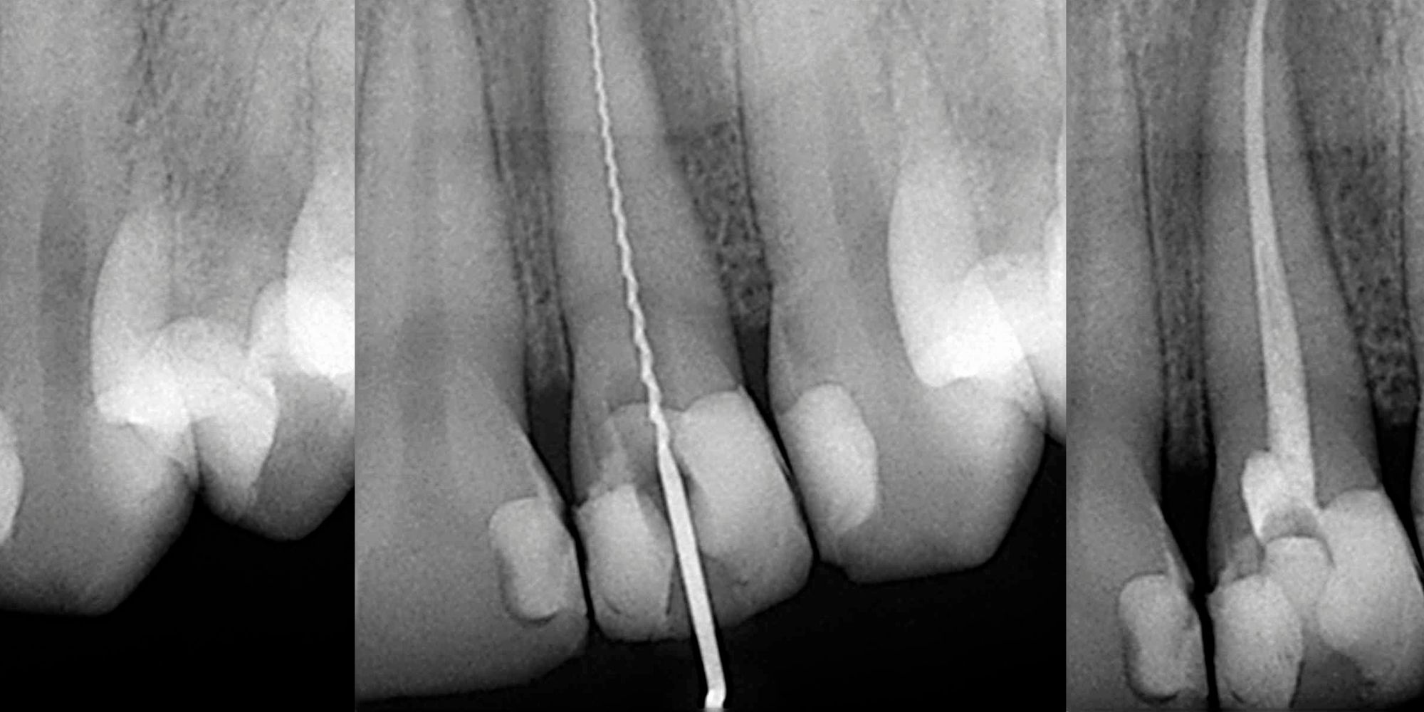 Denervation (endodontic treatment)-oradent.gr