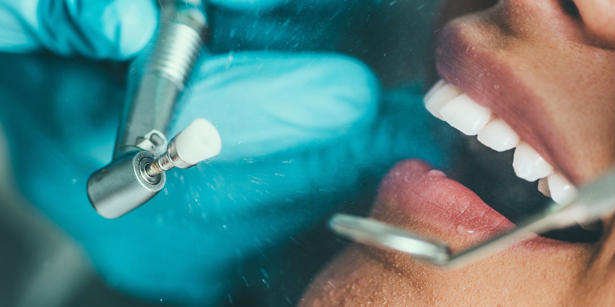 Καθαρισμός και Στίλβωση Δοντιών-oradent.gr