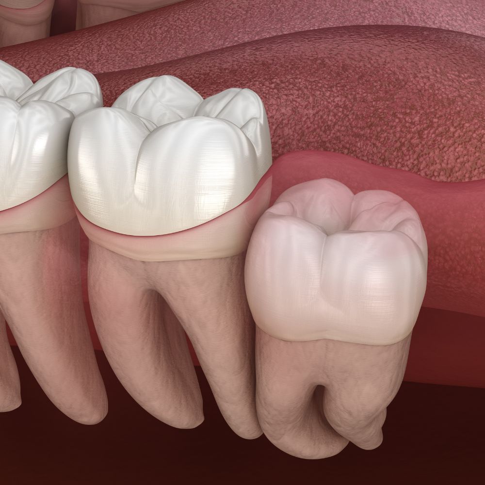 Extraction of an embedded wisdom tooth-oradent.gr