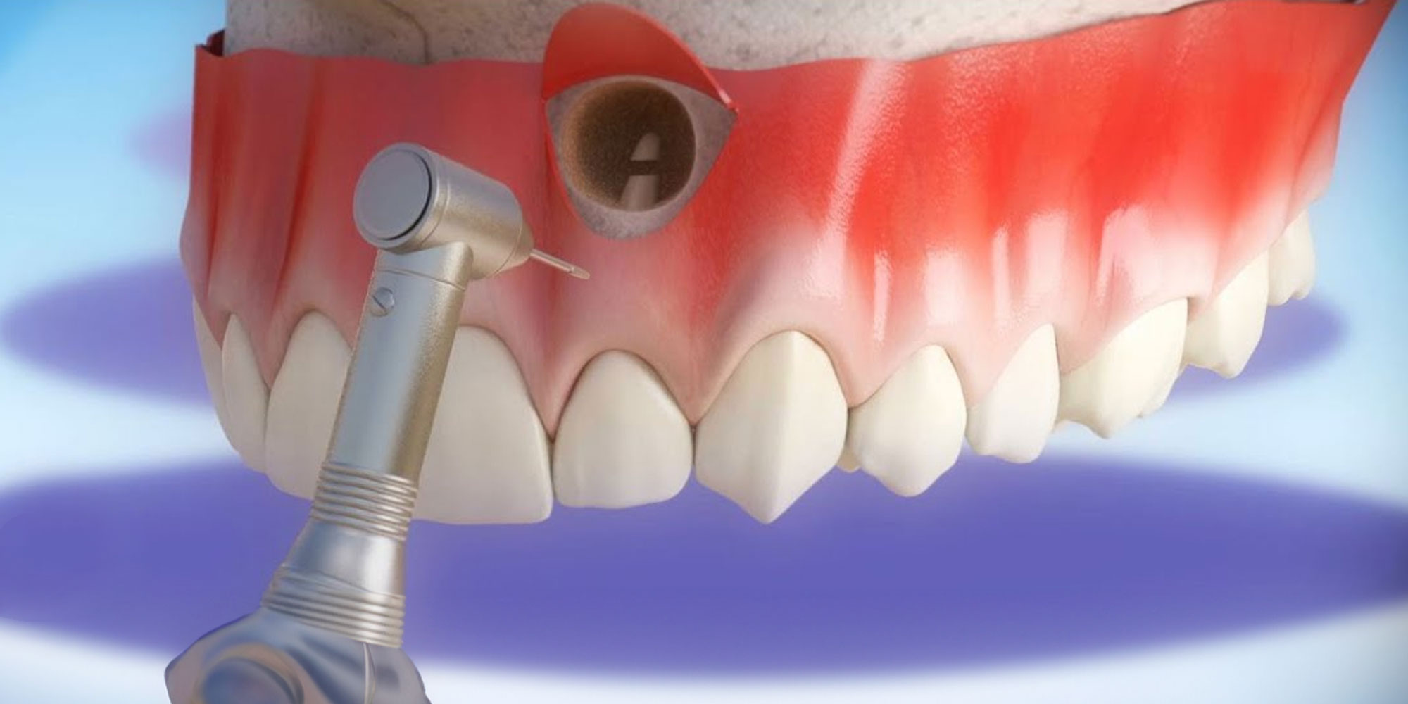 Tooth acrorrhizectomy-oradent.gr