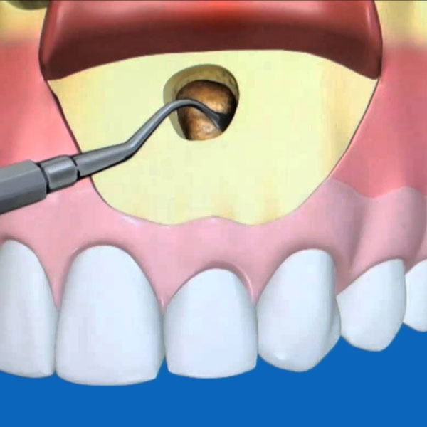 Tooth acrorrhizectomy-oradent.gr