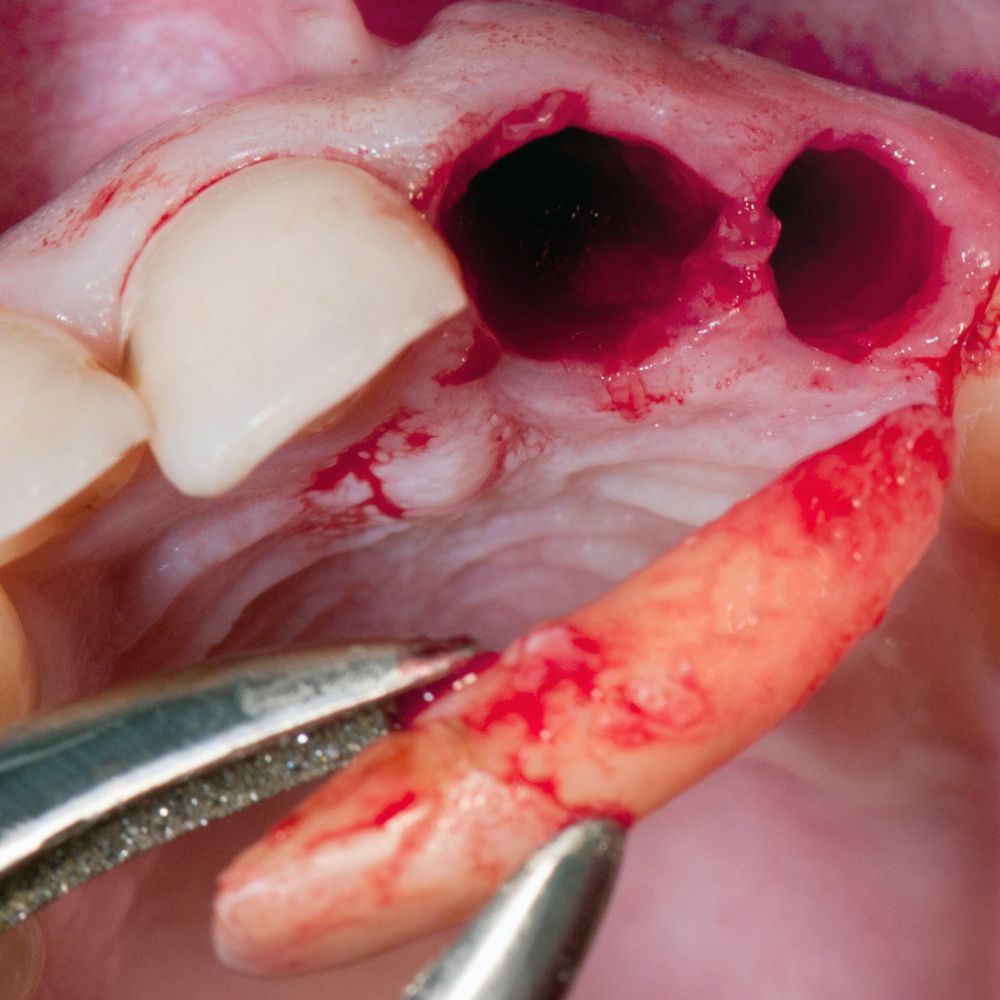 Surgical Tooth Extraction-oradent.gr