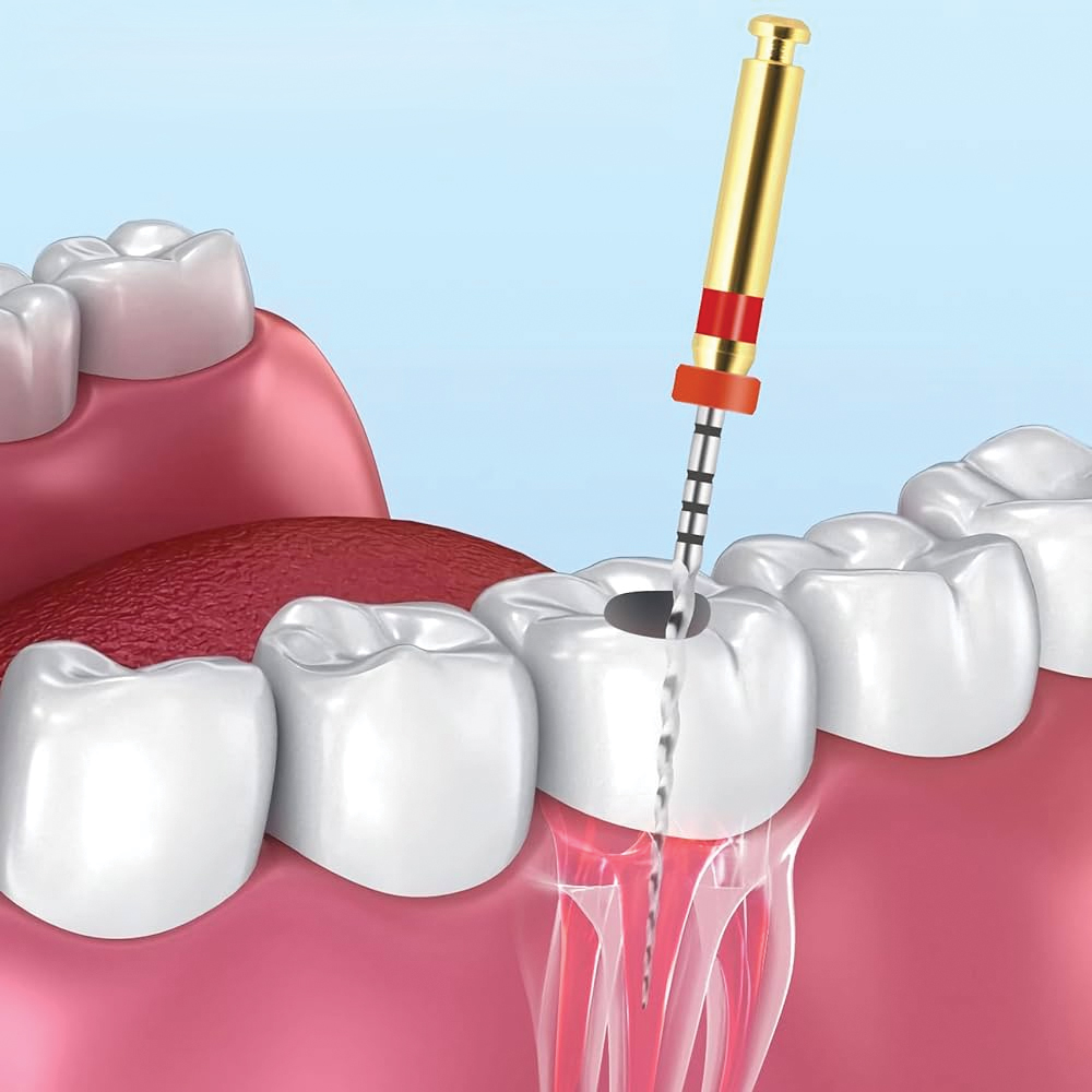 Denervation (endodontic treatment)-oradent.gr