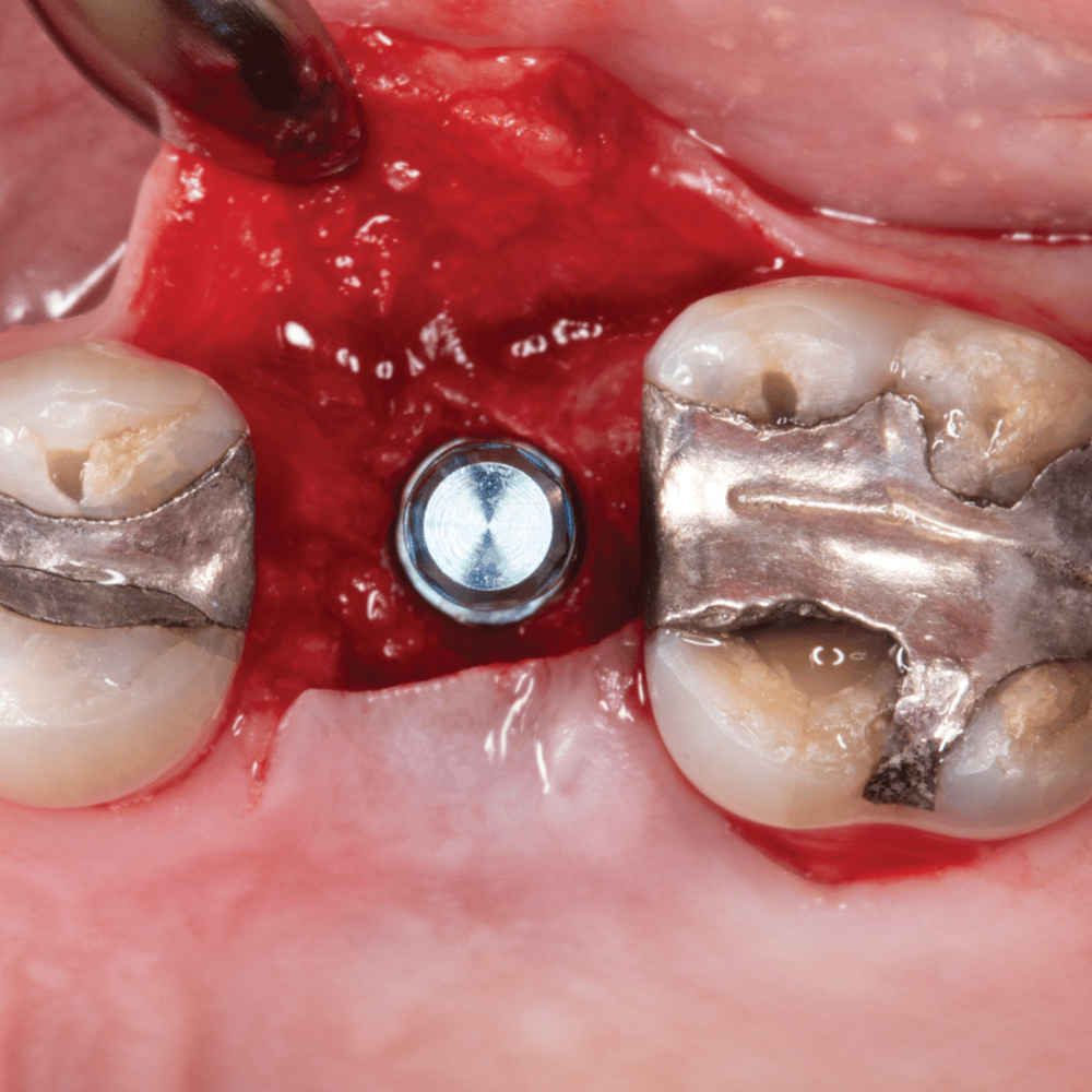 Implants after Extraction-oradent.gr