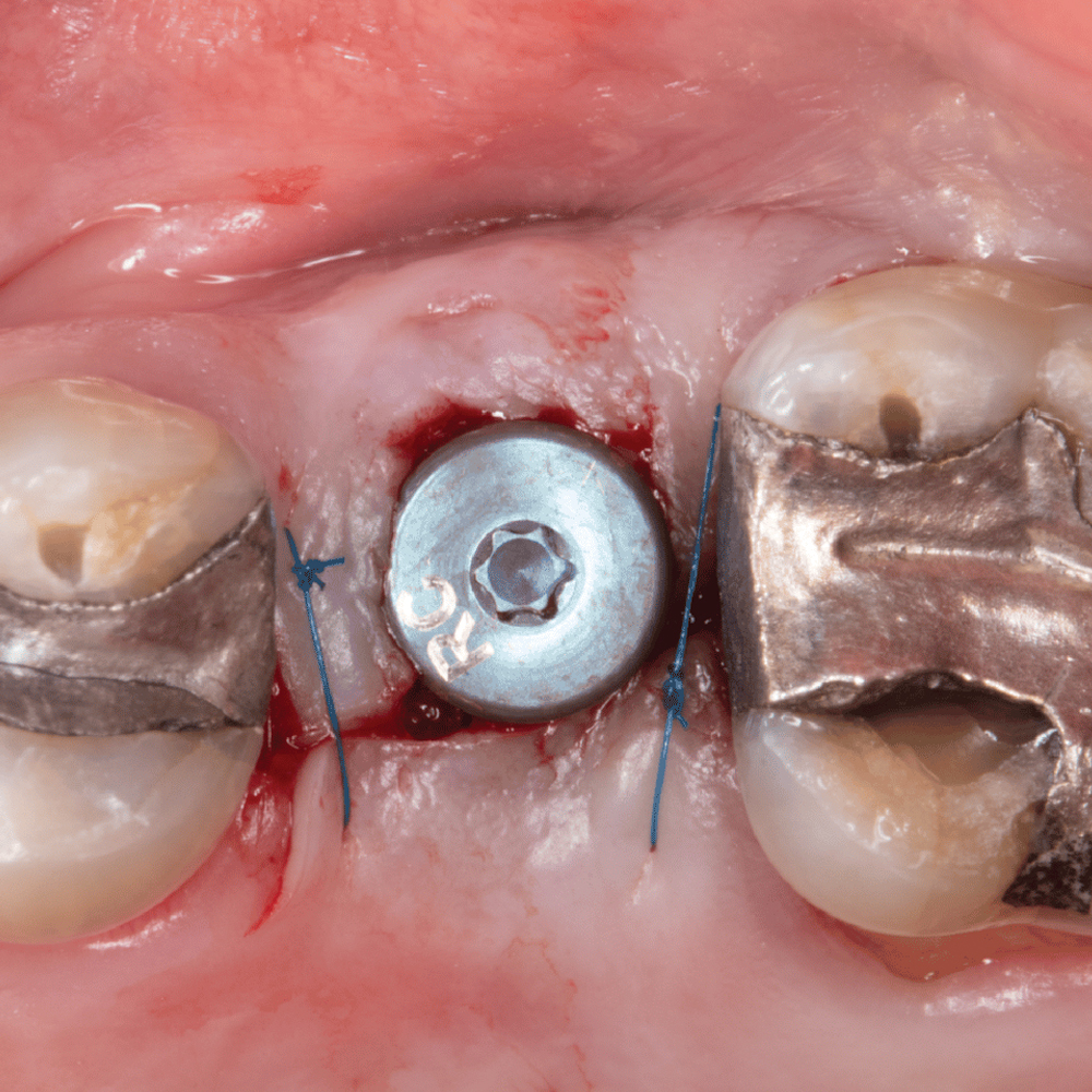 Implants after Extraction-oradent.gr
