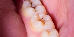 Tooth decay treatment: What you need to know-oradent.gr