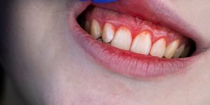 How is gingivitis treated?-oradent.gr