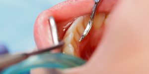 How long after teeth cleaning can I eat?-oradent.gr