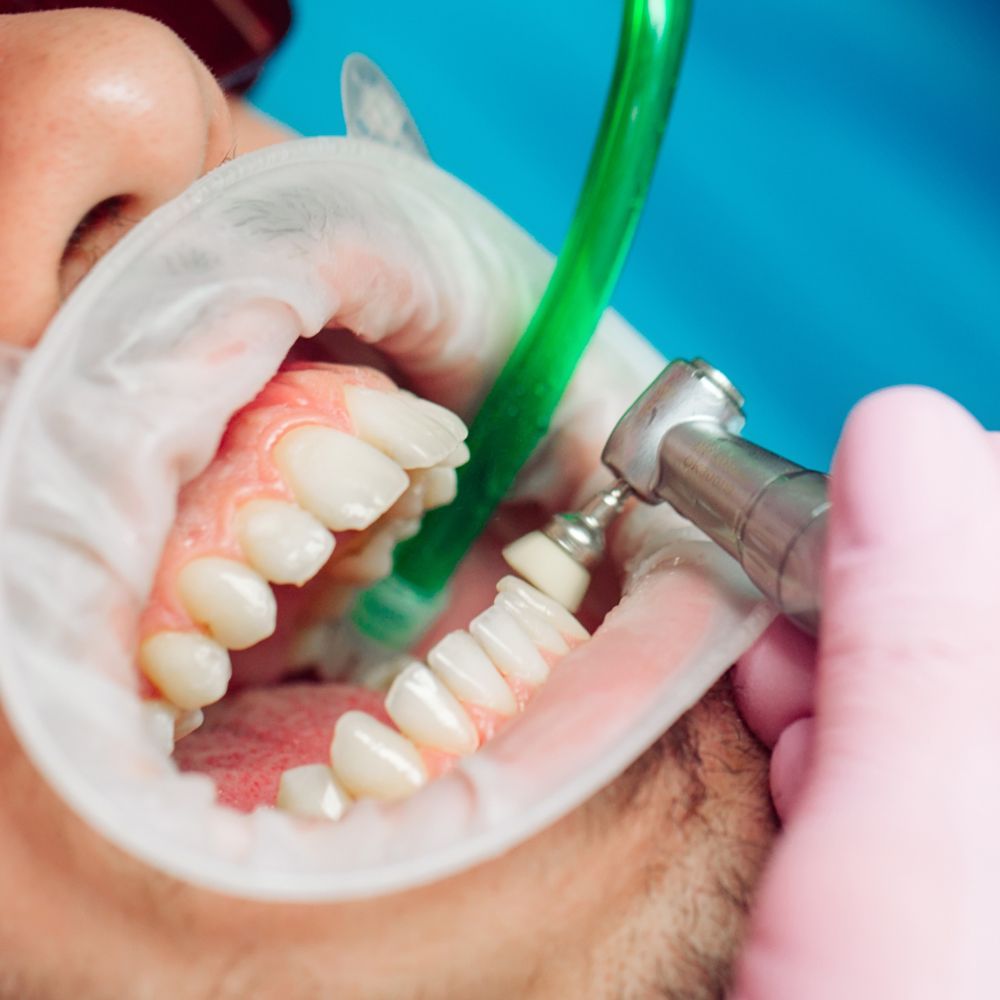 Καθαρισμός και Στίλβωση Δοντιών-oradent.gr