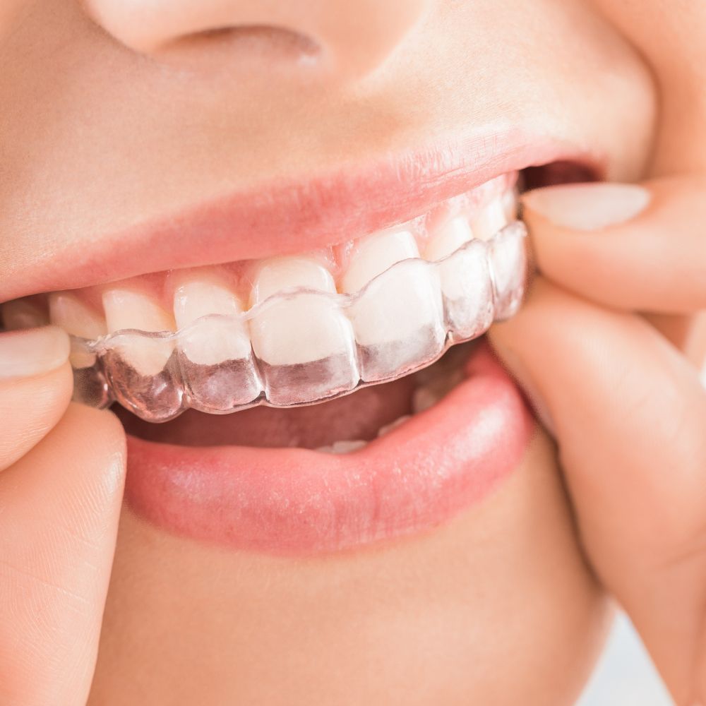 Teeth Whitening-oradent.gr