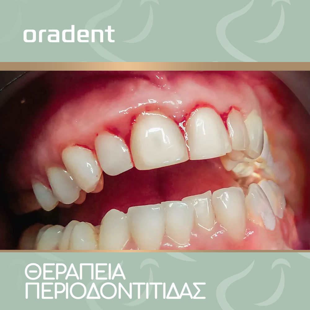 Periodontitis Blog-oradent.gr