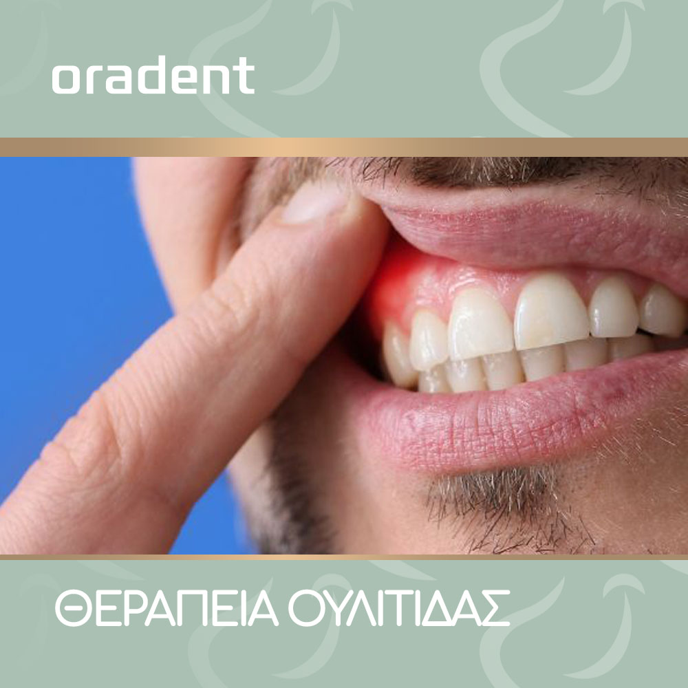 Blog Treatment of Gingivitis-oradent.gr