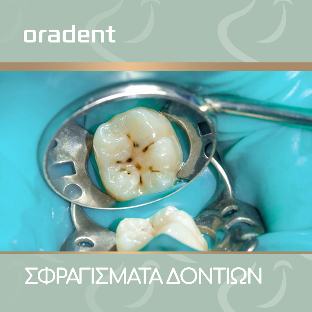 Blog Dental Sealants-oradent.gr