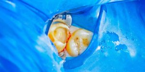 How is a tooth filling done?-oradent.gr