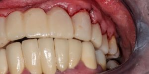 Front tooth filling-oradent.gr