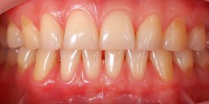Front tooth filling-oradent.gr