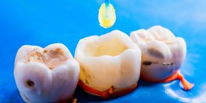 When is a tooth filling needed?-oradent.gr
