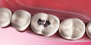 What is a tooth filling?-oradent.gr
