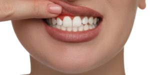 What are the symptoms of gingivitis?-oradent.gr