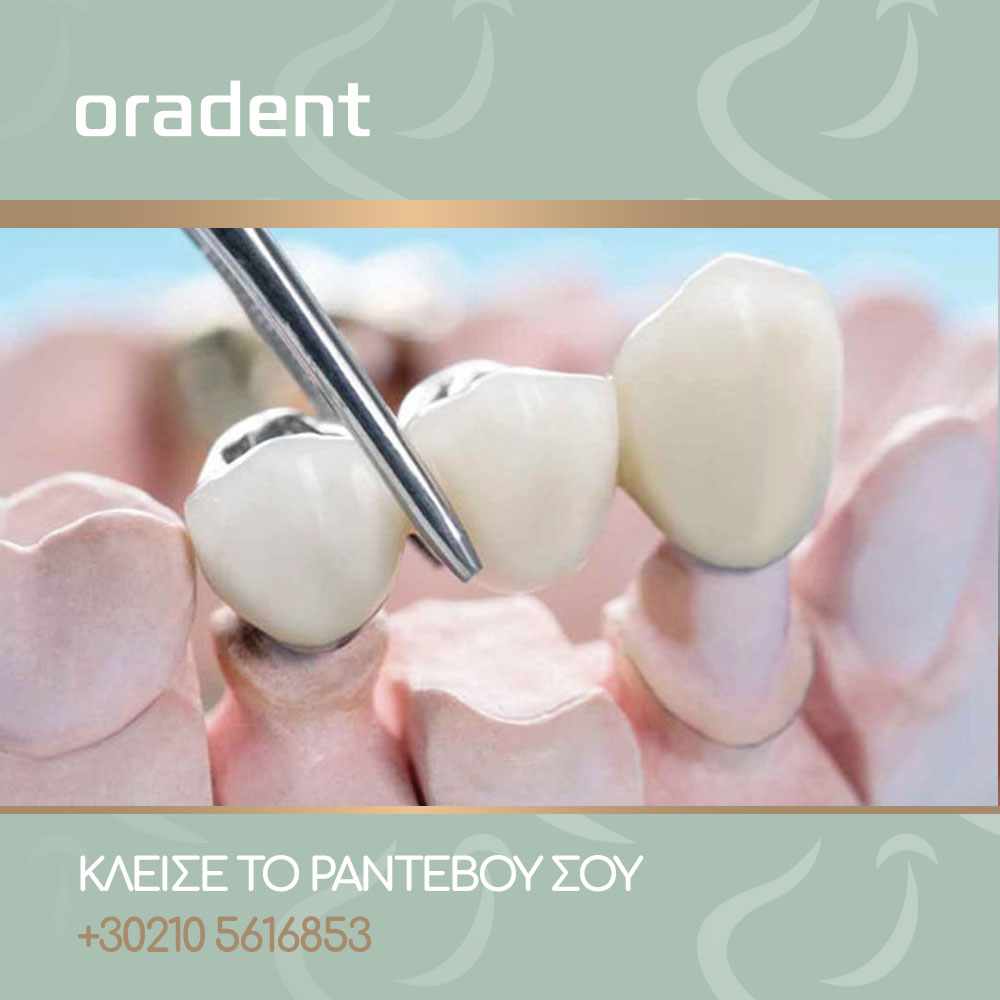 Blog Dental bridge-oradent.gr