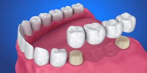 What is a dental bridge?-oradent.gr