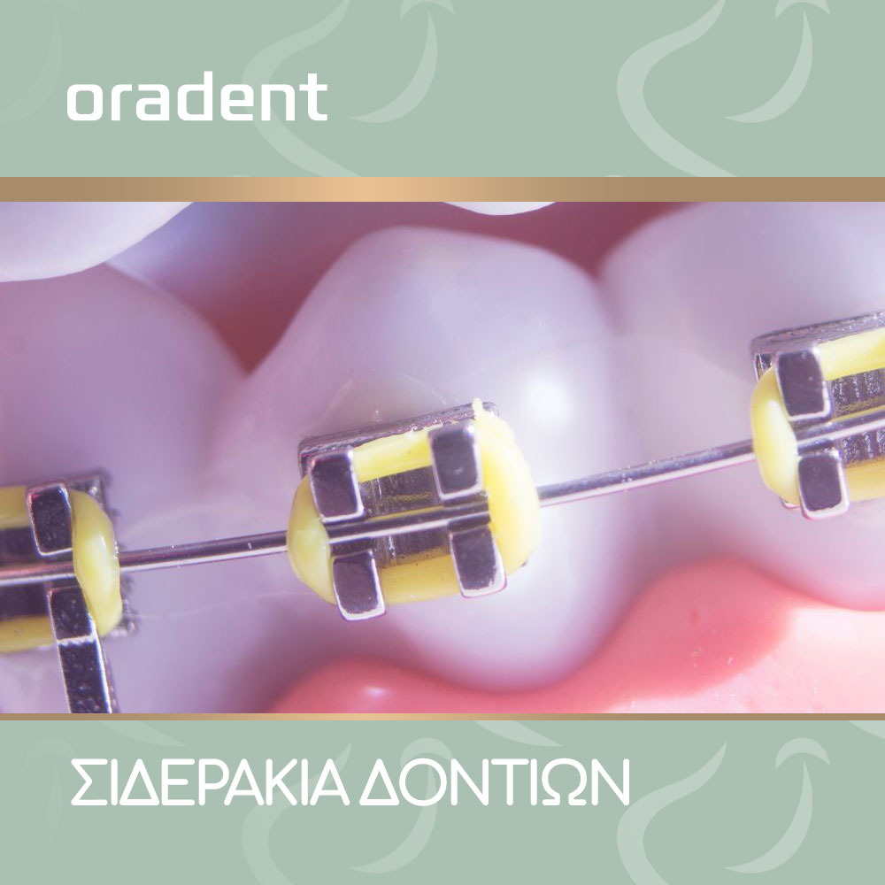 Blog Σιδεράκια Δοντιών-oradent.gr