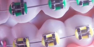 Braces on the teeth: What you need to know-oradent.gr