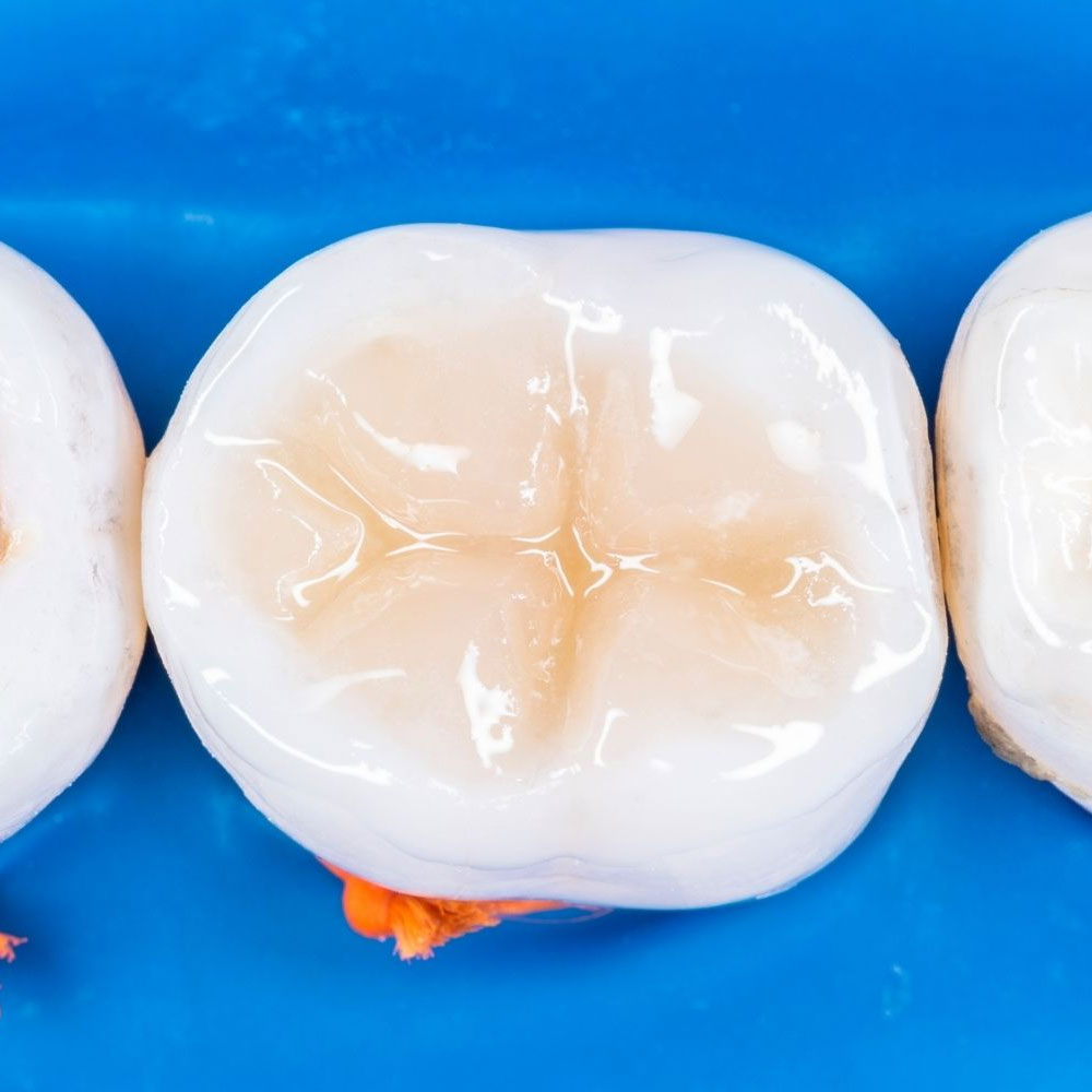 What are sealants?-oradent.gr