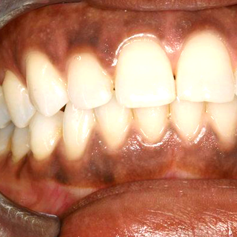 Black gums and treatment-oradent.gr