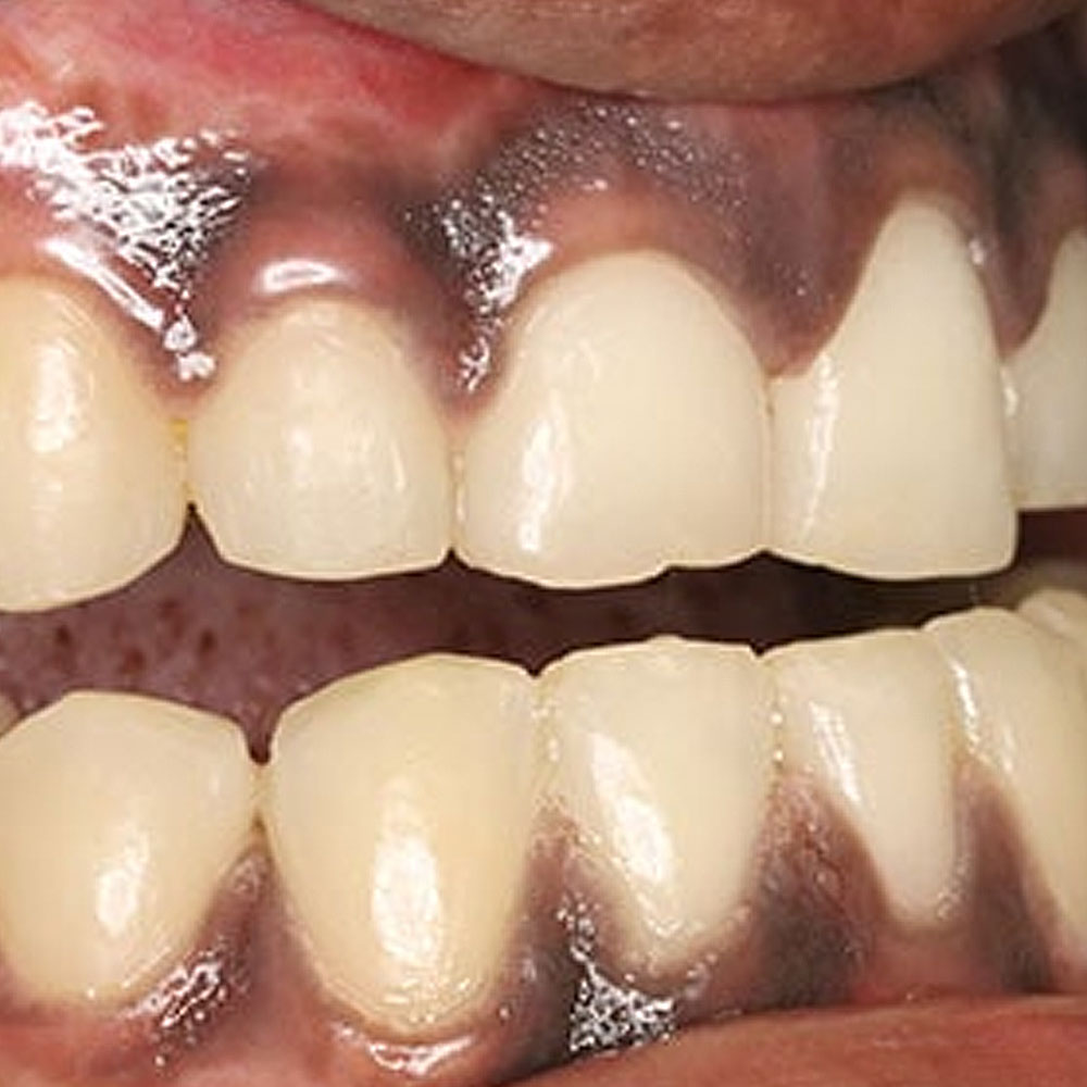 Black gums and treatment-oradent.gr