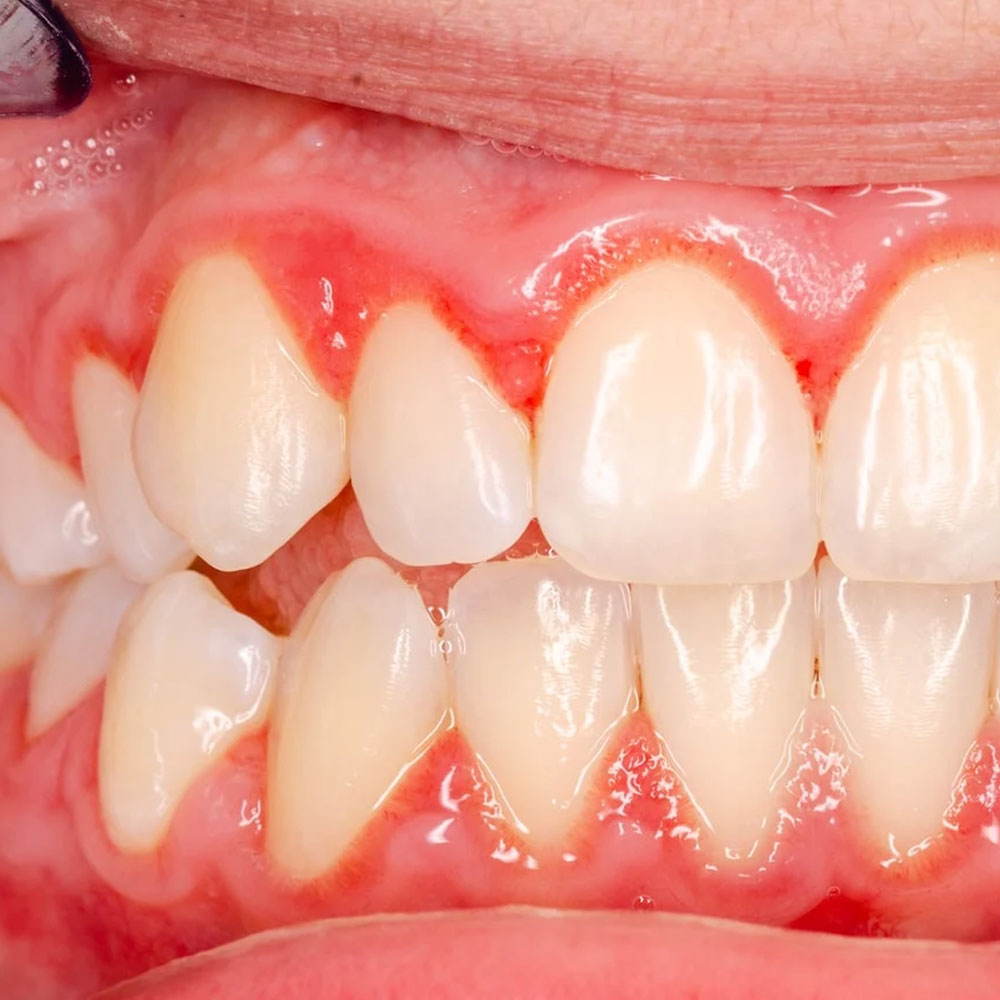 Treatment for periodontitis-oradent.gr