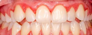 Treatment for periodontitis-oradent.gr
