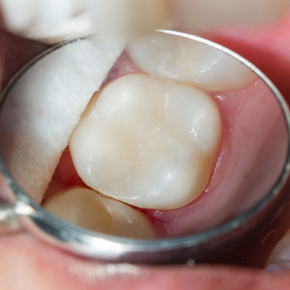 Tooth sealing with resin-oradent.gr